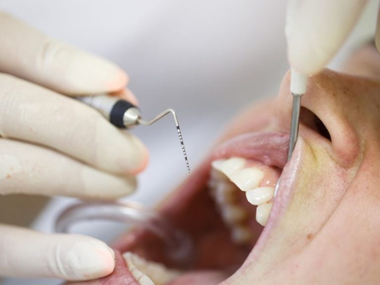 Parodontológiai státuszfelvétel, tasakmélység