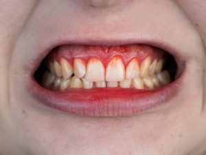 Vérző íny, fogínyvérzés