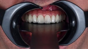 Read more about the article All-on-4