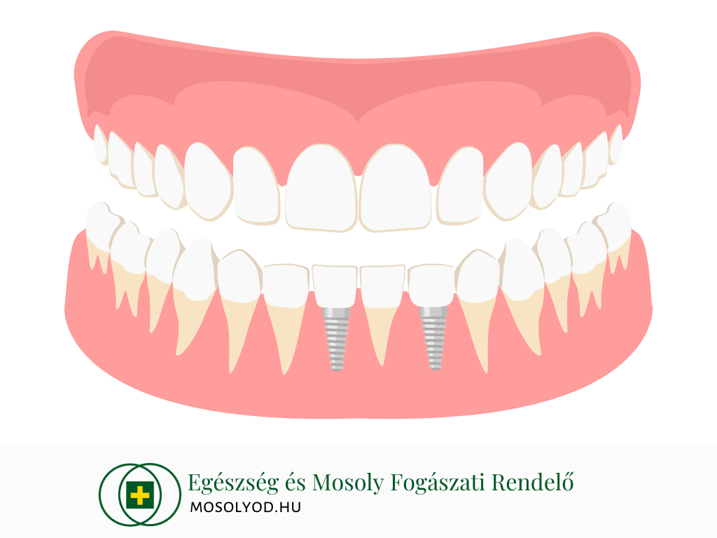 Fogászati implantáció Budapest