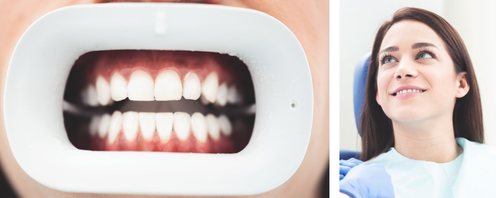 Fogfehérítés 13. kerület