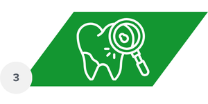 Fogfehérítés folyamata 3