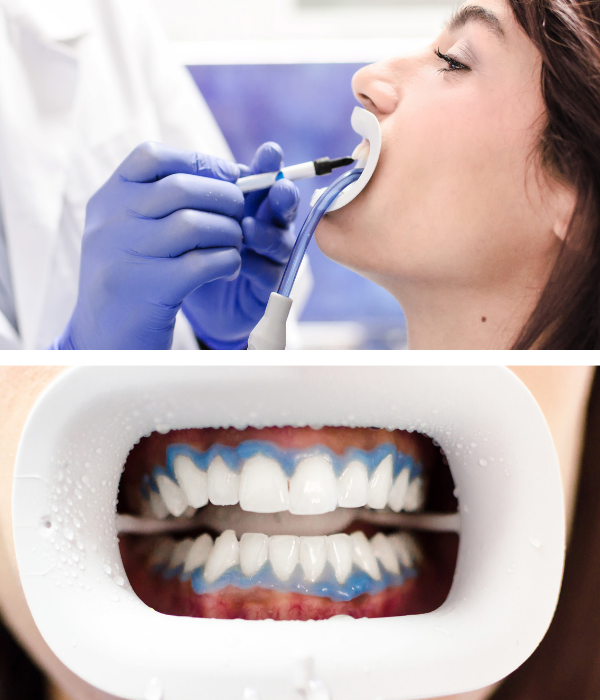 Ínyvédelem professzionális fogfehérítés során