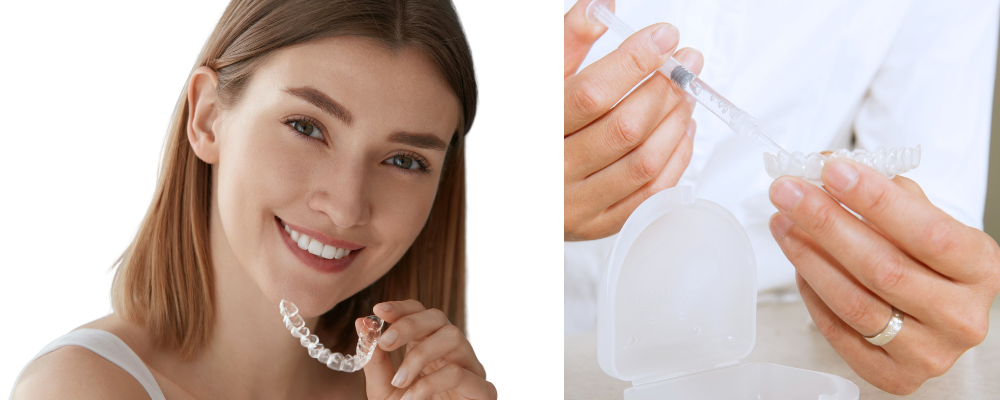 Otthoni fogfehérítés