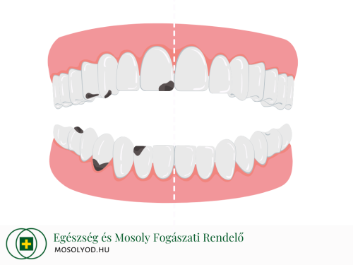 Általános fogászat, fogszuvasodás